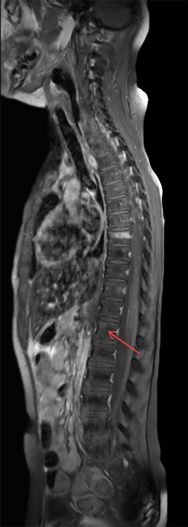 Sagittal T1w TSE SPIR