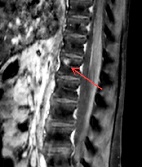Sagittal T1w mDIXON TSE