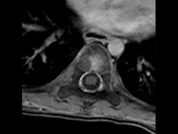 Axial eTHRIVE (post gado)