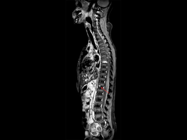 Sagittal T1w mDIXON TSE