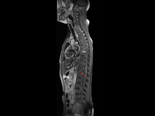 Sagittal T1w TSE SPIR