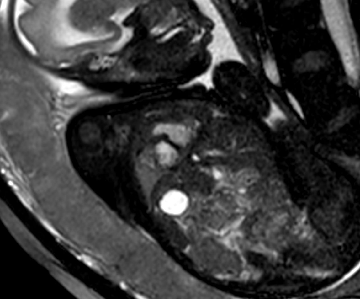 Morphology - bFFE short axis