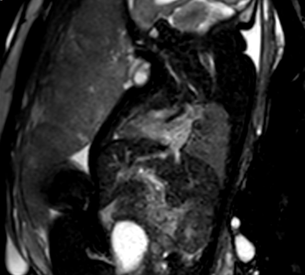 Morphology - bFFE vertical long axis