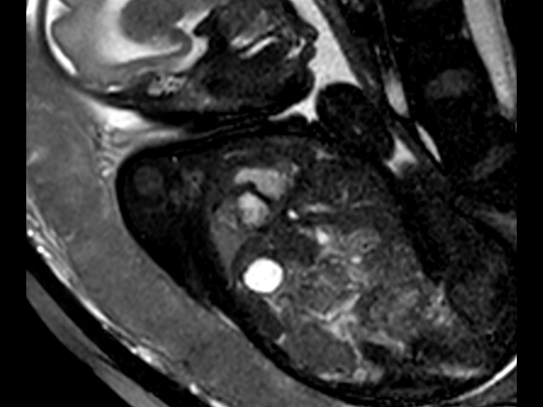 Morphology - bFFE short axis