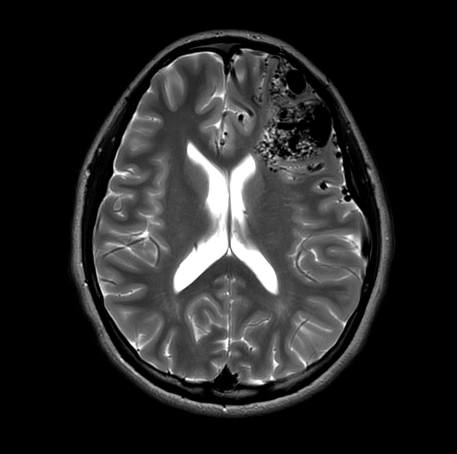 Axial T2w TSE MultiVane XD