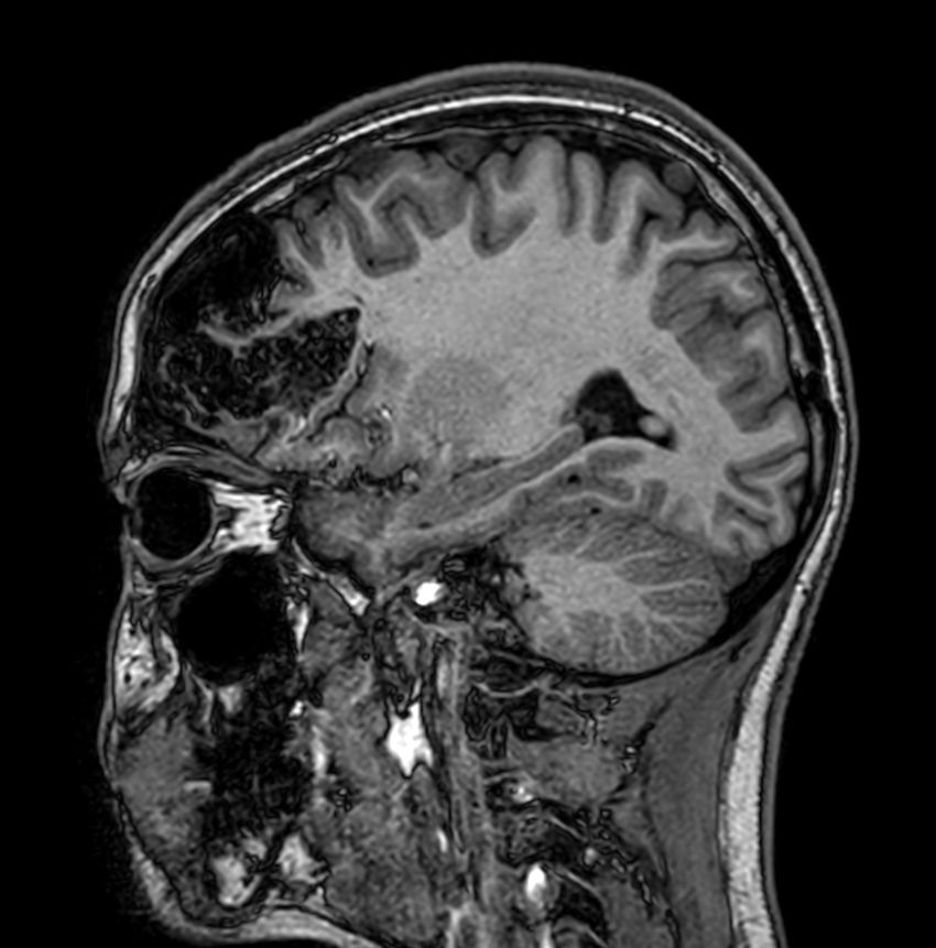Sagittal 3D T1w TFE<b>Compressed SENSE</b>