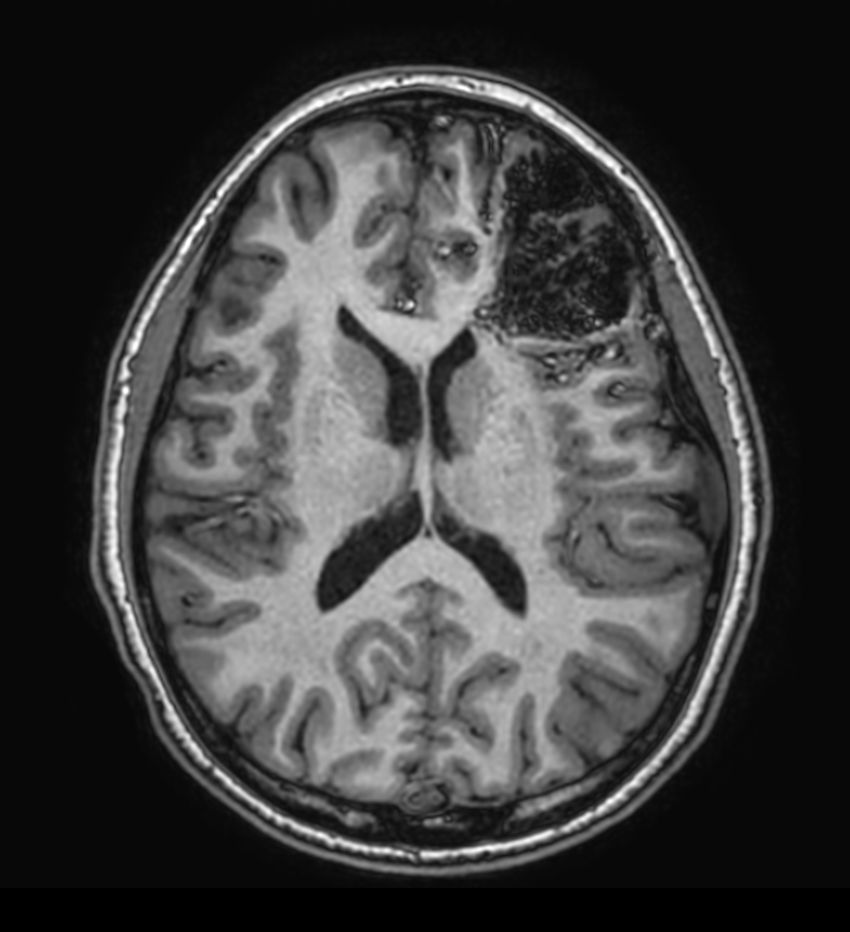 3D T1w TFE - Axial reformat<b>Compressed SENSE</b>