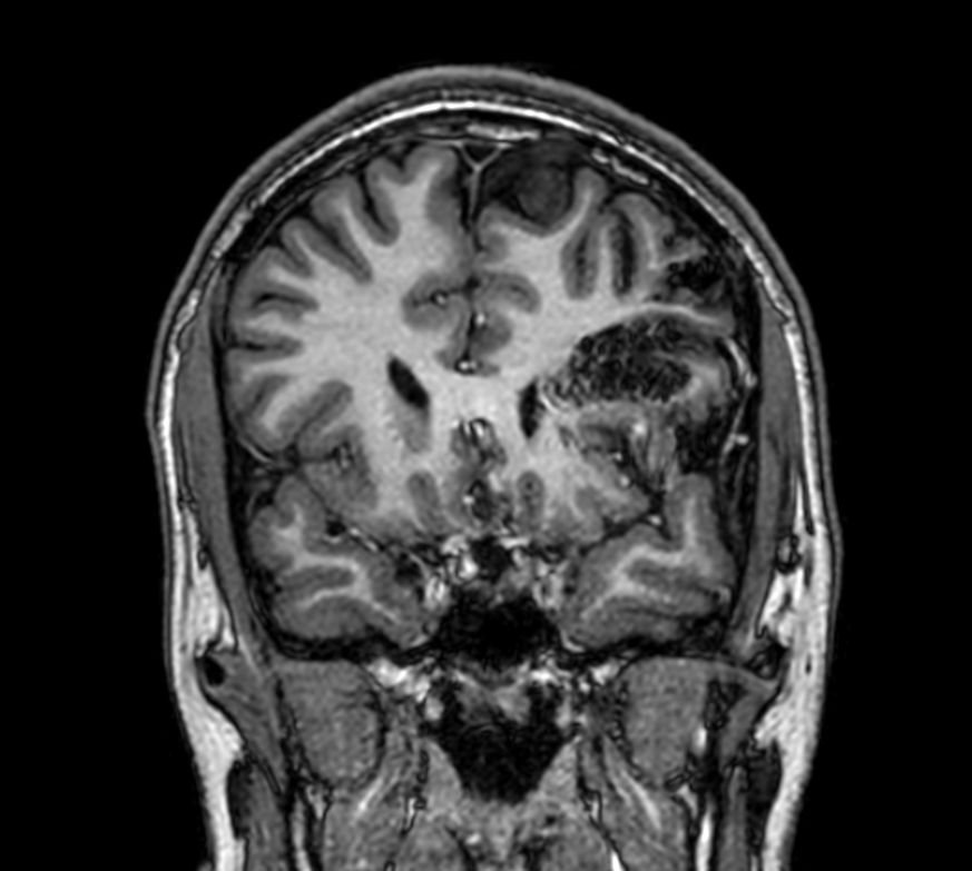 3D T1w TFE - Coronal reformat<b>Compressed SENSE</b>