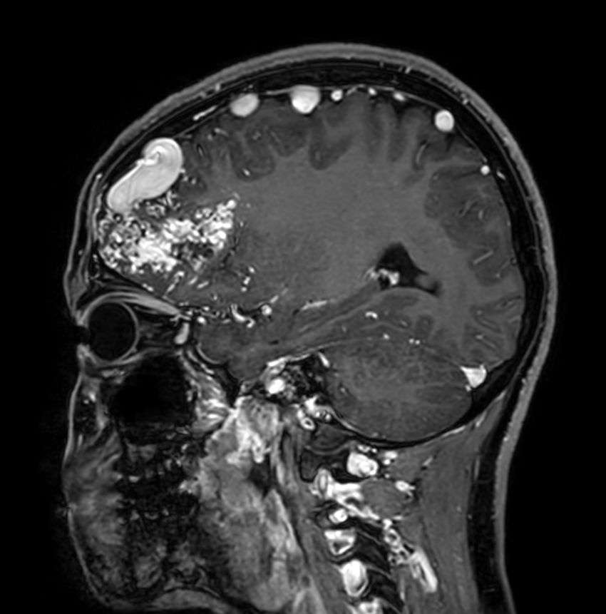 Sagittal 3D T1w TFE +gado<b>Compressed SENSE</b>