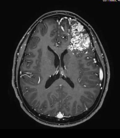 3D T1w TFE +gado - Axial reformat<b>Compressed SENSE</b>