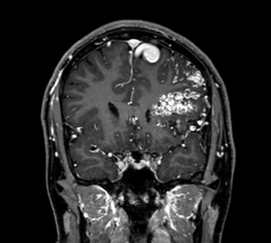 3D T1w TFE +gado - Coronal reformat<b>Compressed SENSE</b>