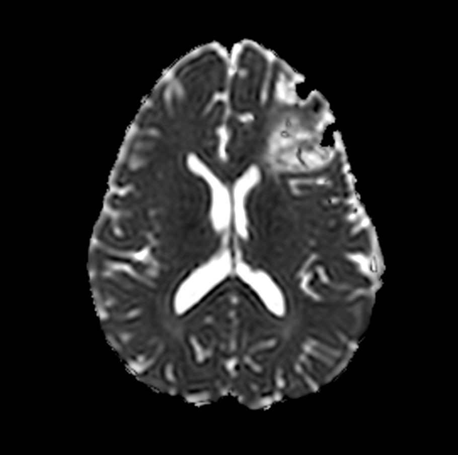 Axial DWI b1000 (ADC)