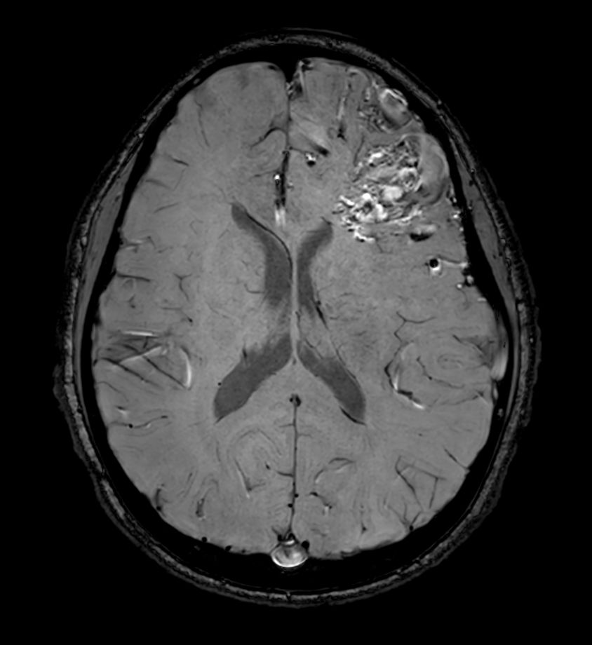 Axial SWIp<b>Compressed SENSE</b>