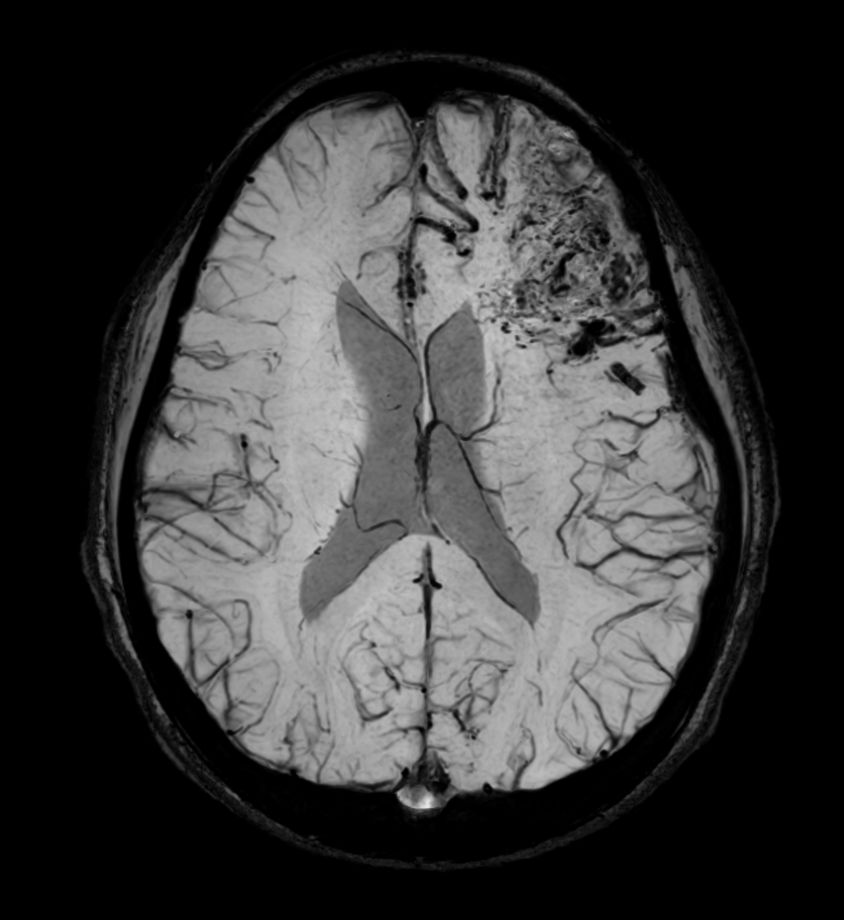 Axial SWIp (minIP)<b>Compressed SENSE</b>