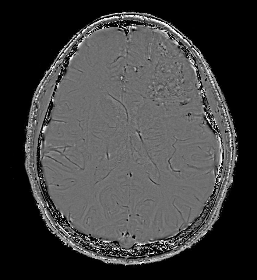 Axial SWIp (Phase)<b>Compressed SENSE</b>