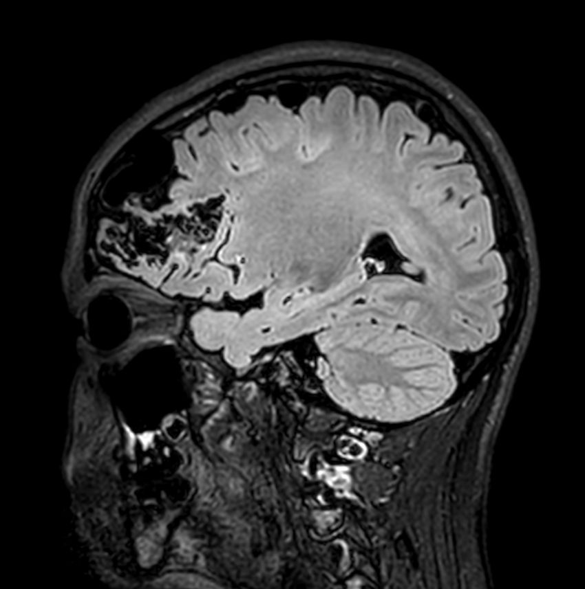 Sagittal 3D T2w FLAIR<b>Compressed SENSE</b>
