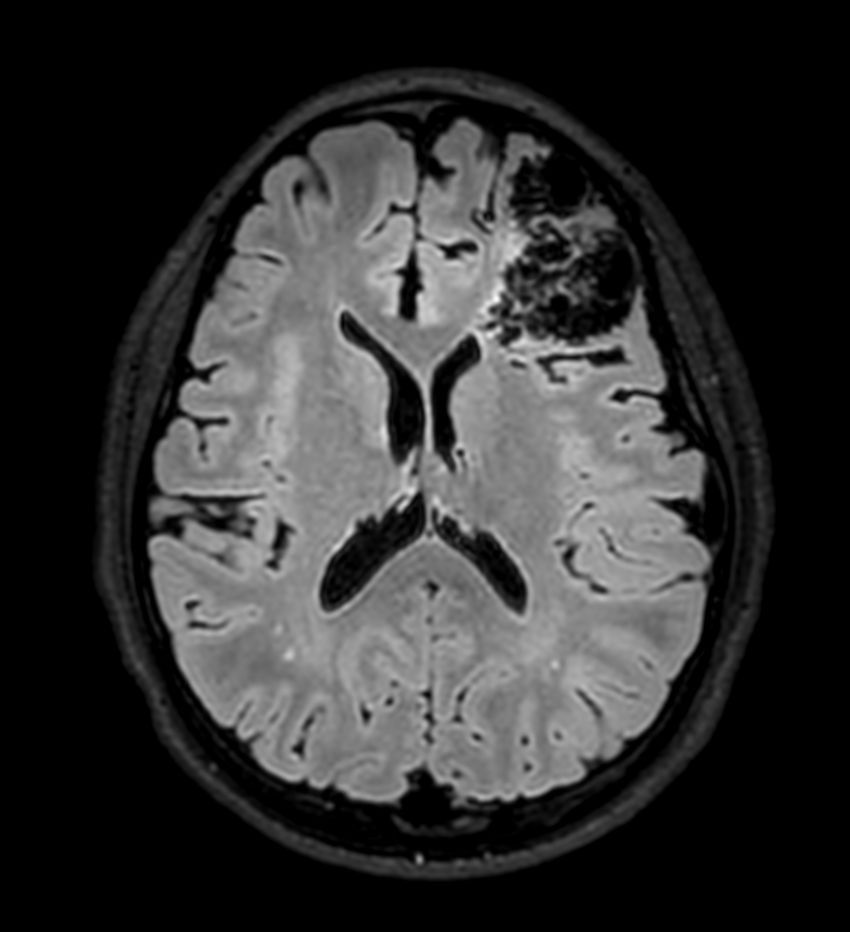 3D T2w FLAIR - Axial reformat<b>Compressed SENSE</b>