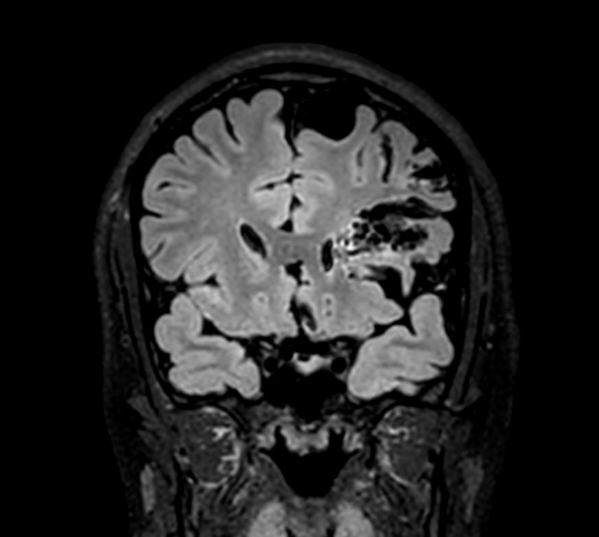 3D T2w FLAIR - Coronal reformat<b>Compressed SENSE</b>