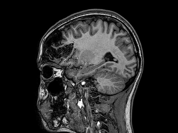 Sagittal 3D T1w TFE<b>Compressed SENSE</b>