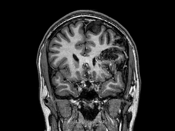 3D T1w TFE - Coronal reformat<b>Compressed SENSE</b>