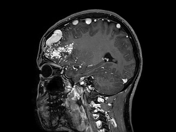 Sagittal 3D T1w TFE +gado<b>Compressed SENSE</b>