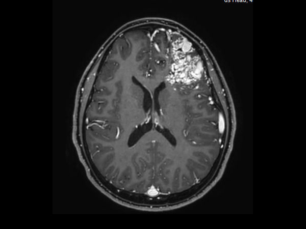 3D T1w TFE +gado - Axial reformat<b>Compressed SENSE</b>