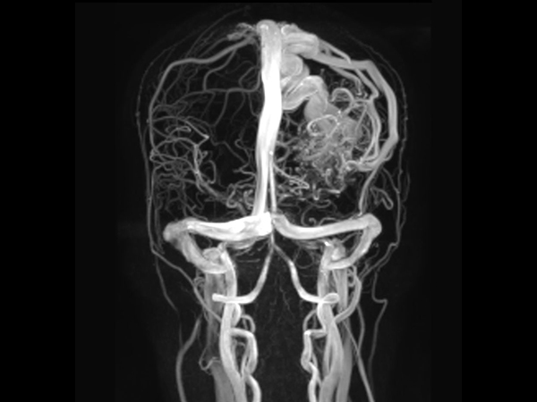 Coronal 3D PCA<b>Compressed SENSE</b>