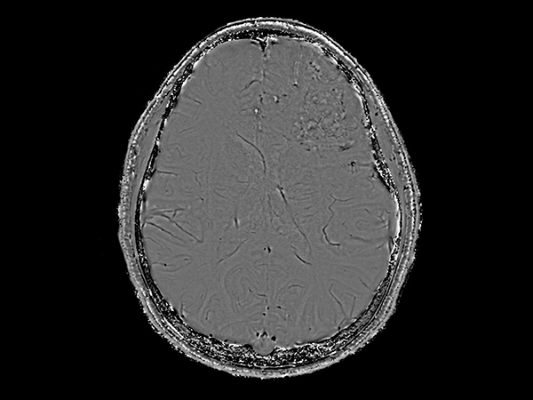 Axial SWIp (Phase)<b>Compressed SENSE</b>