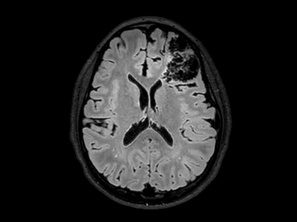 3D T2w FLAIR - Axial reformat<b>Compressed SENSE</b>