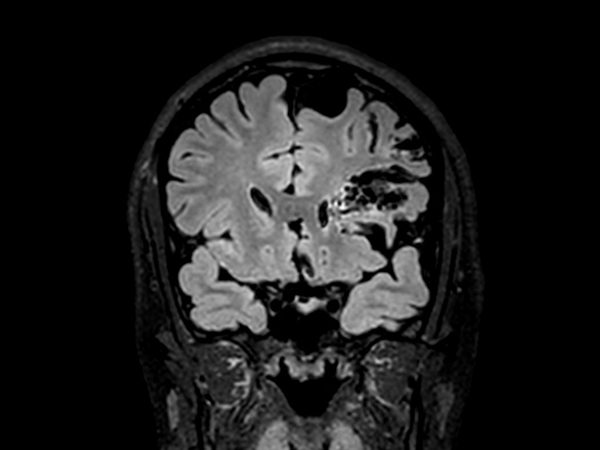 3D T2w FLAIR - Coronal reformat<b>Compressed SENSE</b>