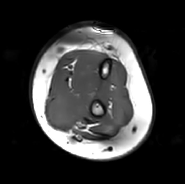 Axial T1w TSE<b>Compressed SENSE</b>