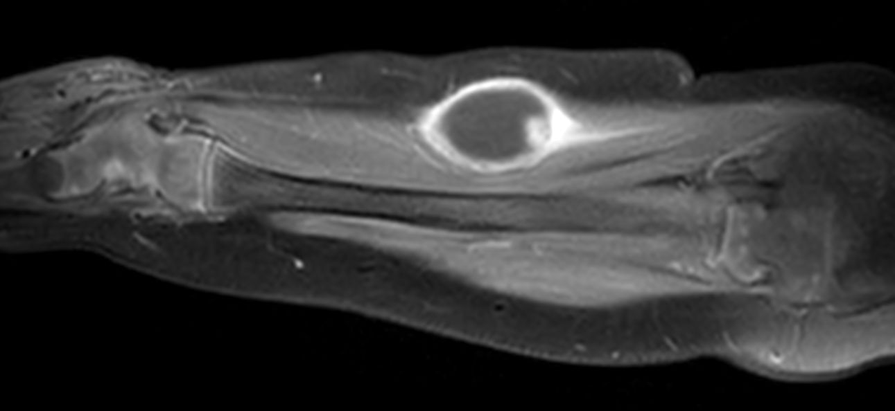 Sagittal T1w FatSat +gado<b>Compressed SENSE</b>