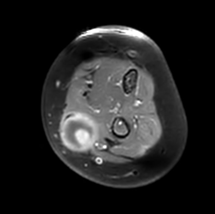 Axial T1w FatSat +gado<b>Compressed SENSE</b>