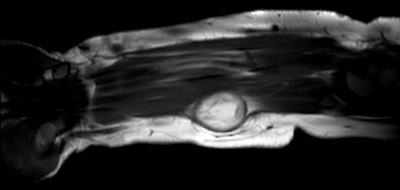 Coronal T2w mDIXON XD (In Phase)<b>Compressed SENSE</b>