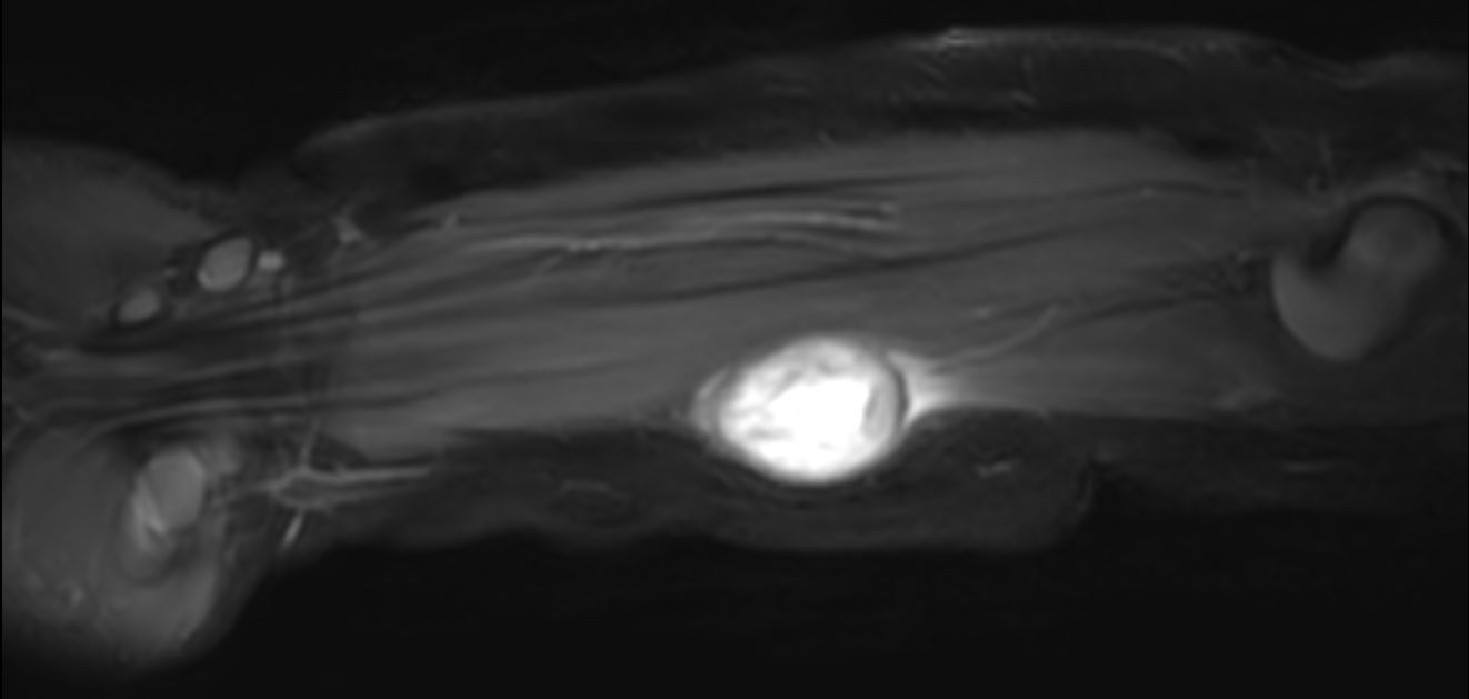 Coronal T2w mDIXON XD (Water only)<b>Compressed SENSE</b>