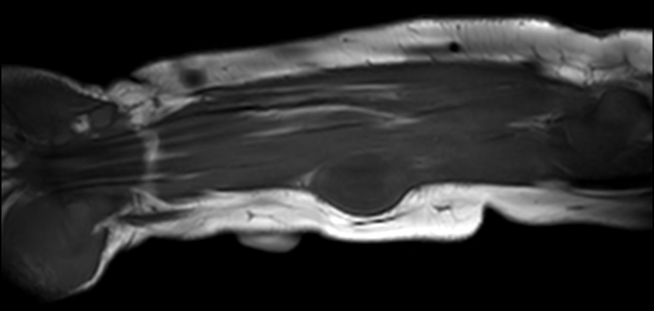 Coronal T1w TSE<b>Compressed SENSE</b>