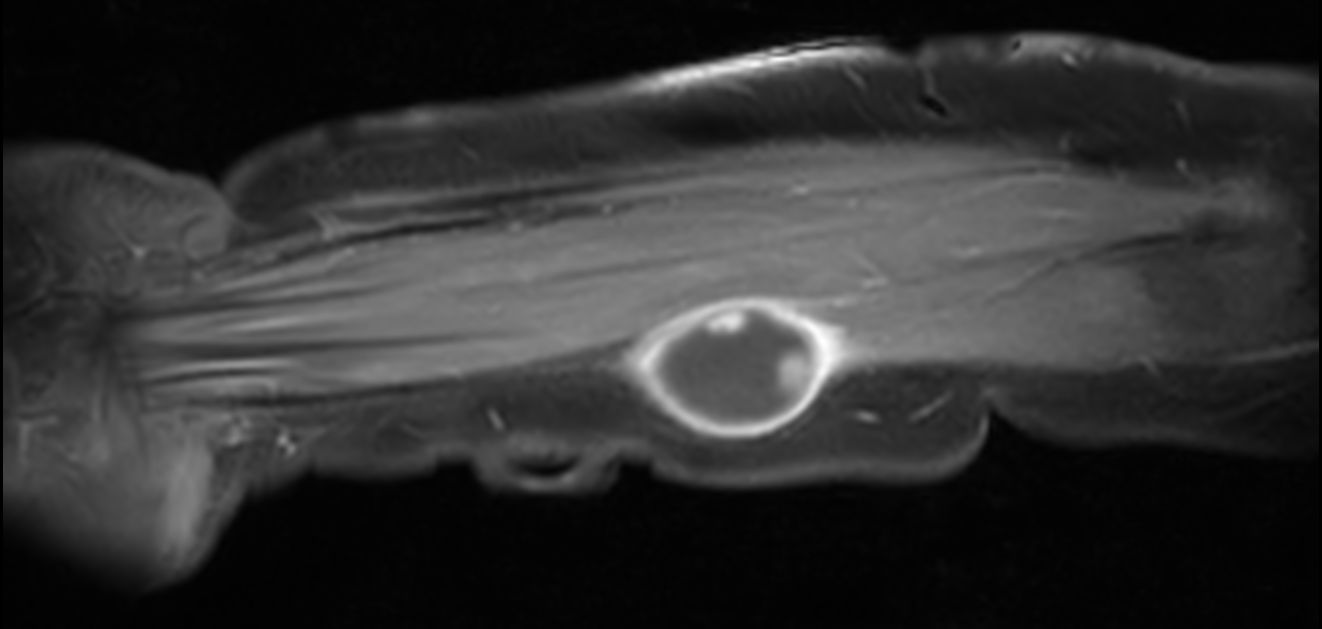 Coronal T1w FatSat +gado<b>Compressed SENSE</b>