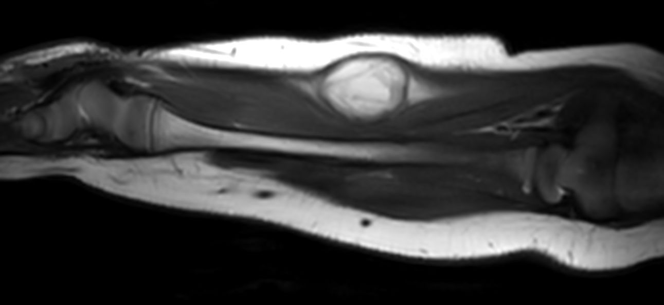 Sagittal T2w mDIXON XD (In Phase)<b>Compressed SENSE</b>