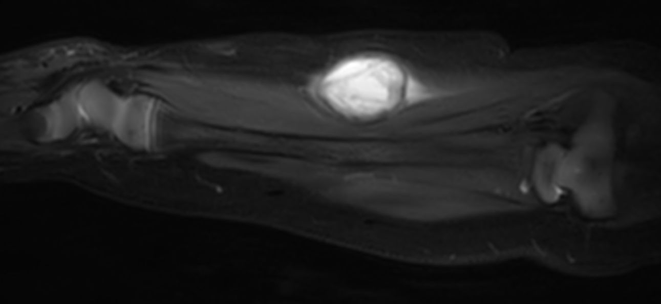 Sagittal T2w mDIXON XD (Water only)<b>Compressed SENSE</b>