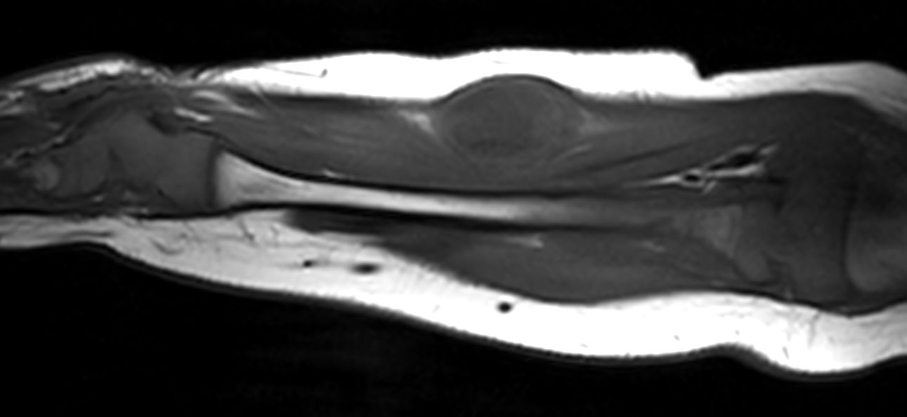 Sagittal T1w TSE<b>Compressed SENSE</b>