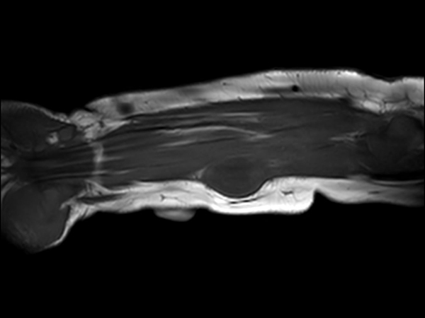 Coronal T1w TSE<b>Compressed SENSE</b>