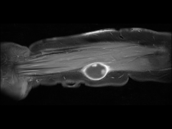 Coronal T1w FatSat +gado<b>Compressed SENSE</b>