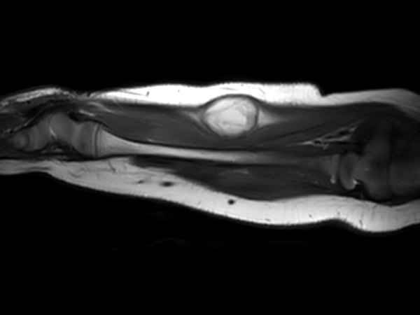 Sagittal T2w mDIXON XD (In Phase)<b>Compressed SENSE</b>