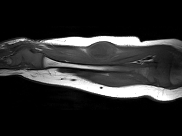 Sagittal T1w TSE<b>Compressed SENSE</b>