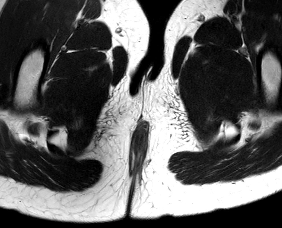 Axial T2w TSE <b>Compressed SENSE</b>