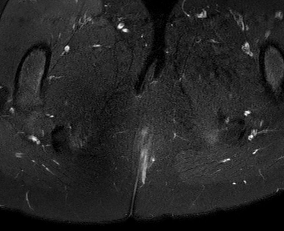 Axial T2w FatSat<b>Compressed SENSE</b>