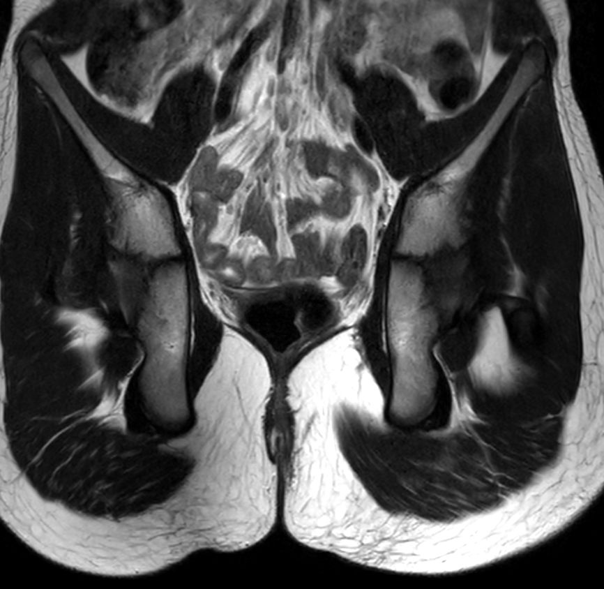 Coronal T2w TSE<b>Compressed SENSE</b>