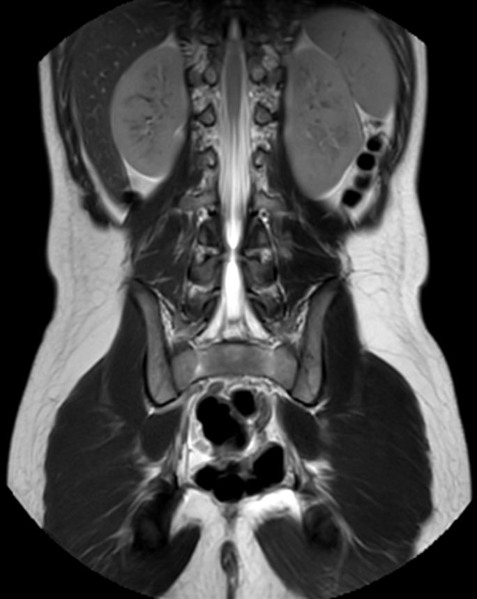 Coronal T2w TSE MultiVane XD