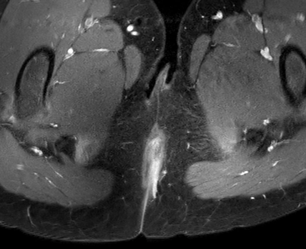Axial T1w FatSat +gado<b>Compressed SENSE</b>