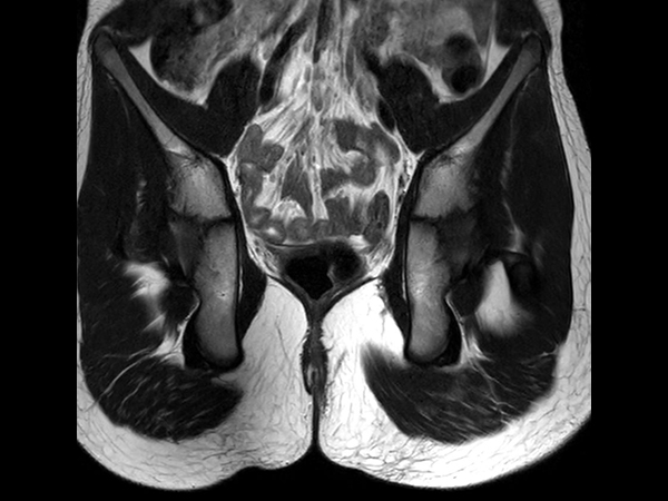 Coronal T2w TSE<b>Compressed SENSE</b>